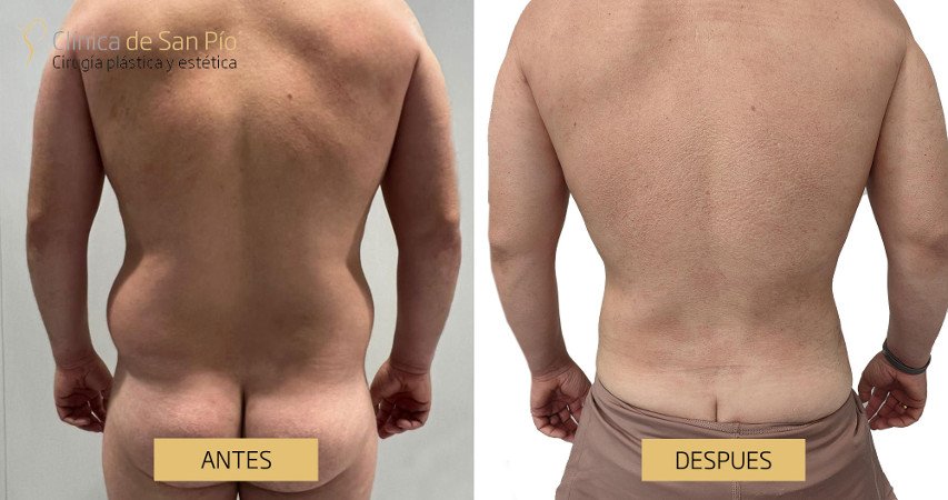 Lipoescultura, antes y despues
