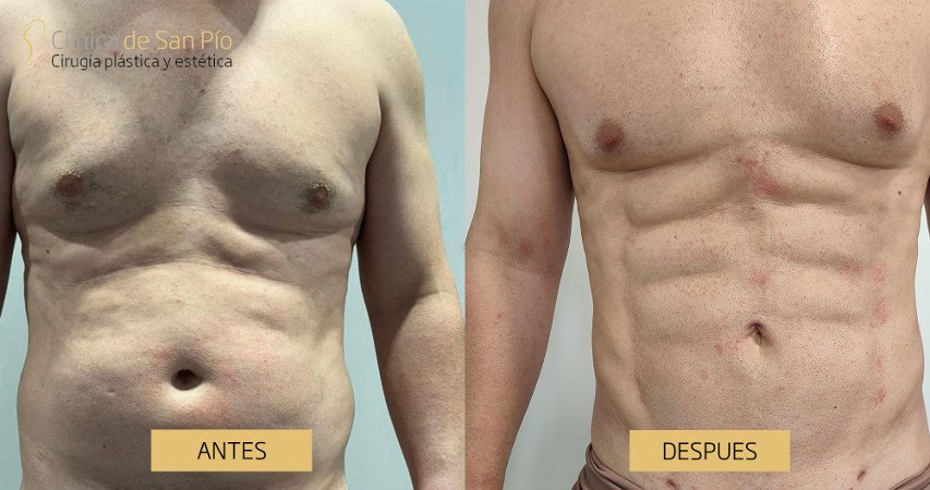 Lipoescultura, antes y despues