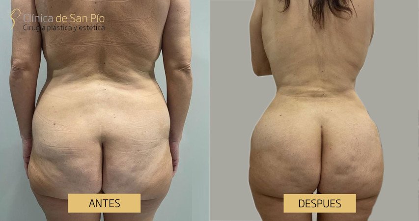Lipoescultura, antes y despues