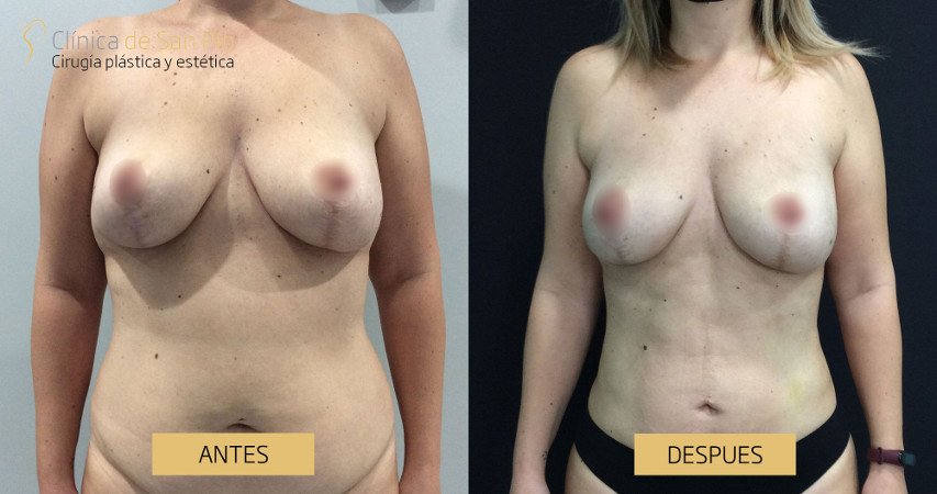 Lipoescultura, antes y despues