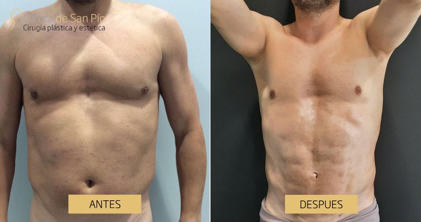 Lipoescultura, antes y despues