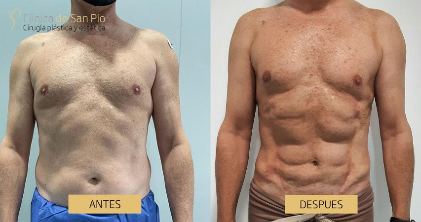 Lipoescultura, antes y despues