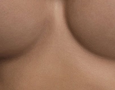 Asimetría mamaria en almería