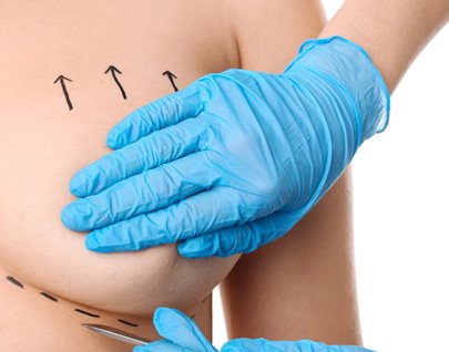 Mastopexia o levantamiento mamas