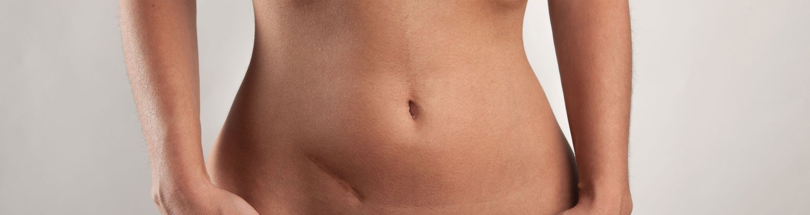 Lipotransferencia para la corrección de defectos cicatrices