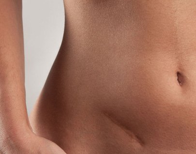 Lipotransferencia para la corrección de defectos cicatrices