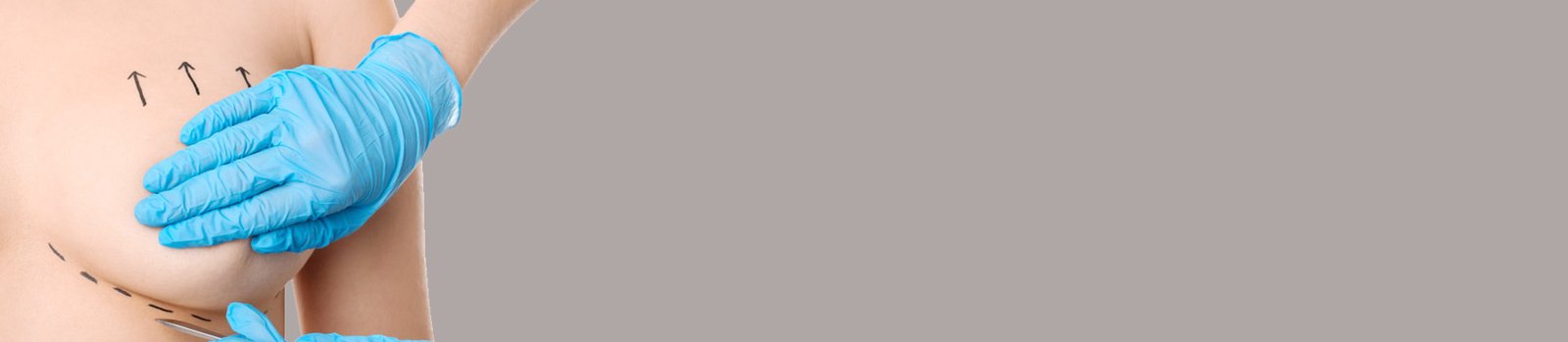 Mastopexia o levantamiento mamas