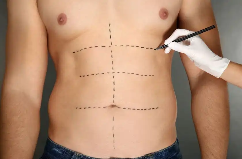 marcacion abdominal la cirugia que mas exito tiene entre los hombre