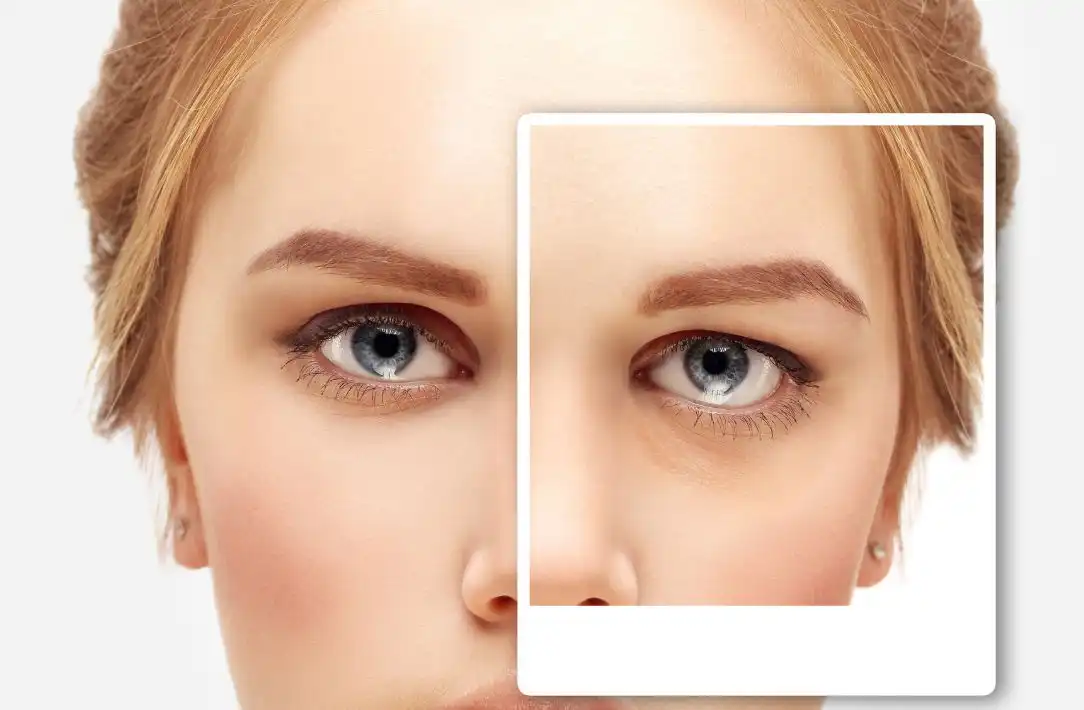 todo lo que necesitas saber sobre la cirugia de parpados