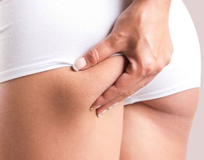 Tratamientos para eliminar celulitis
