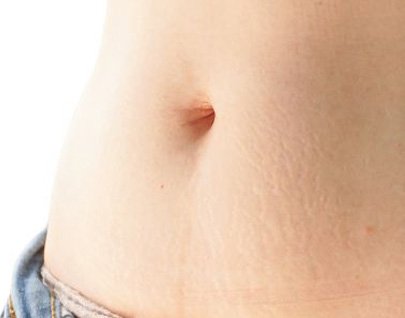 Tratamiento para eliminar estrías