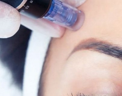 Tratamientos con Dermapen