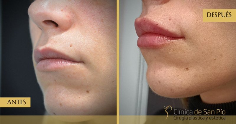 Relleno de labios antes y despues