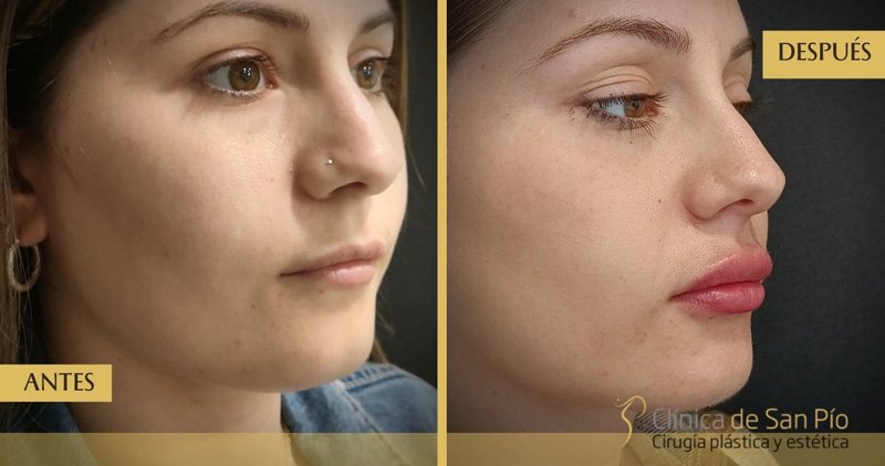 Relleno de labios antes y despues