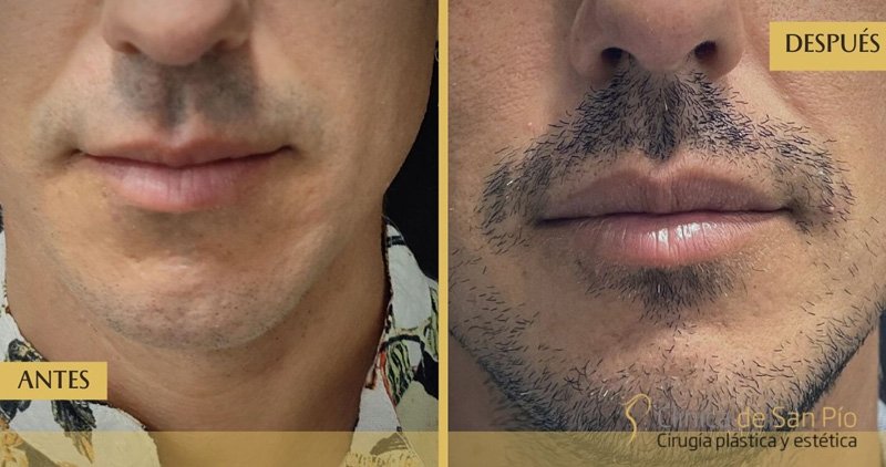 Relleno de labios antes y despues