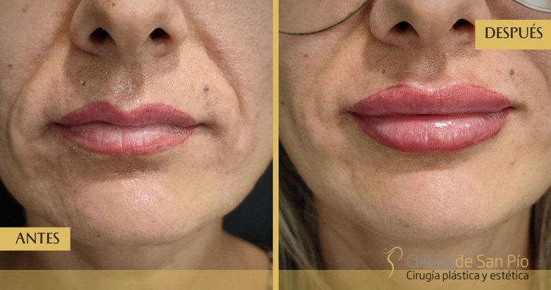 Relleno de labios antes y despues