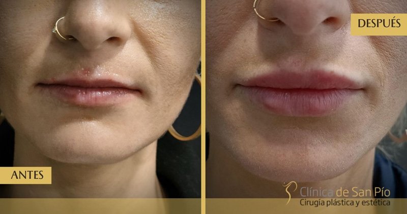 Relleno de labios antes y despues