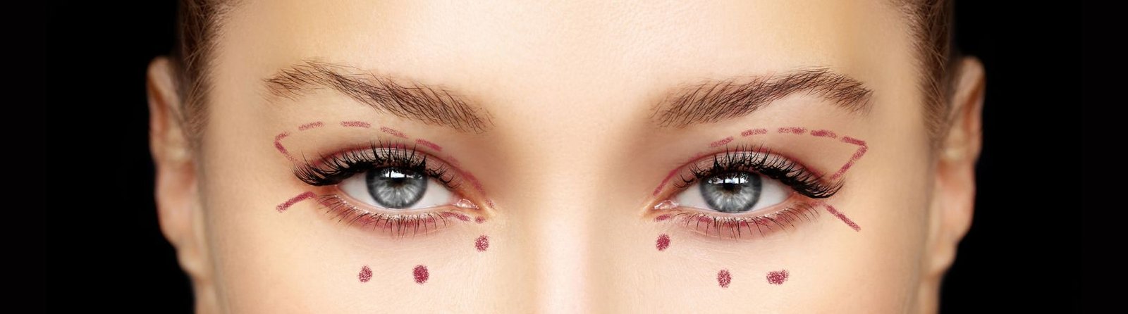 Blefaroplastia en Almería