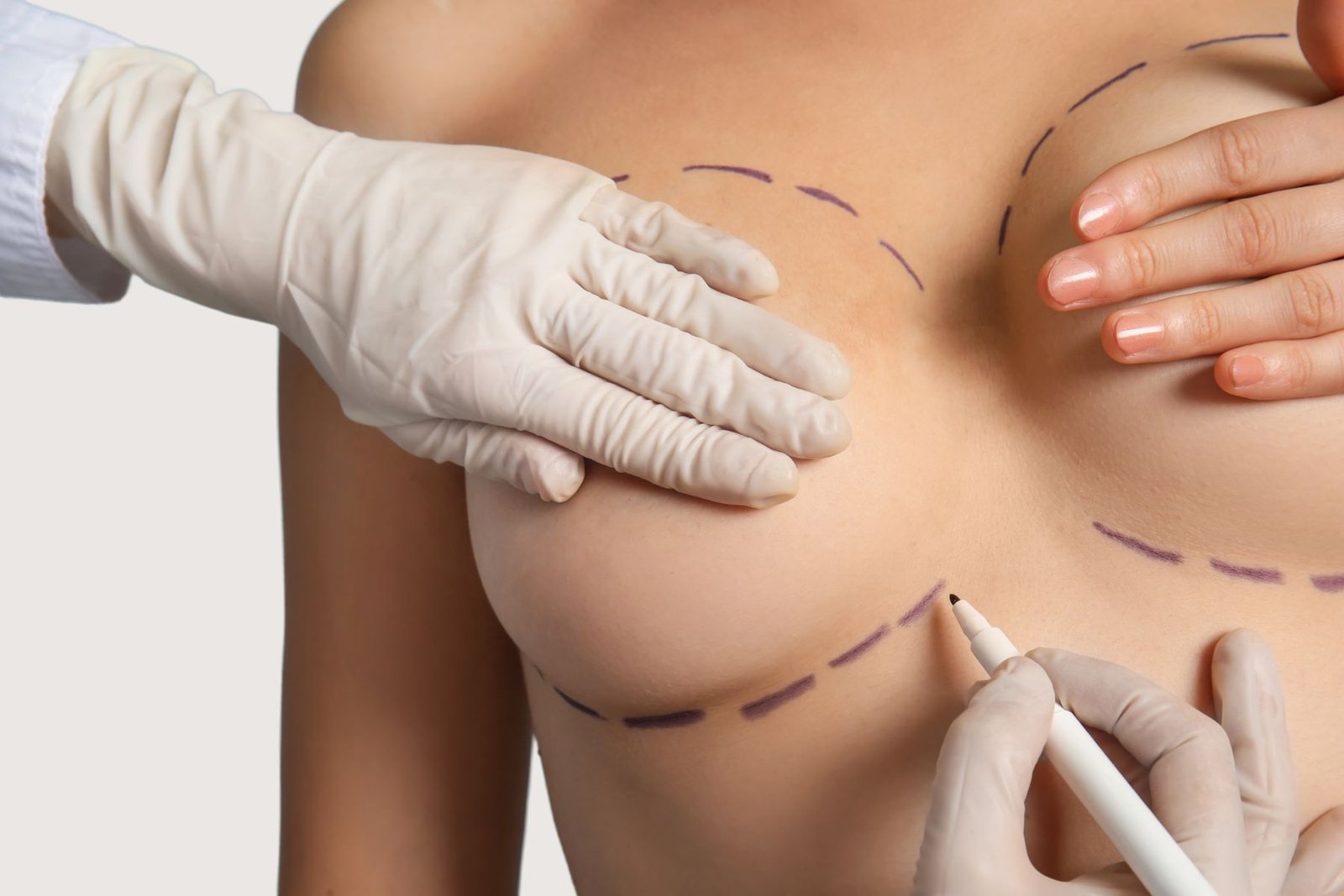 Precio de cirugía estética, aumento de pecho